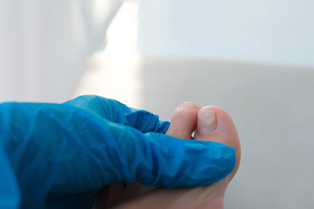 pedicure in oosterbeek medi pedi zorg infectie